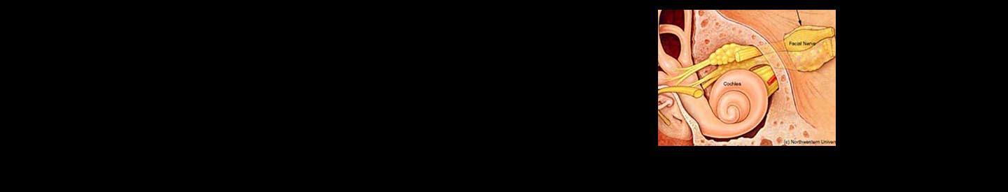 Acoustic Neuroma