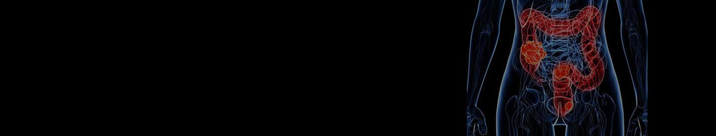 Colorectal Cancer