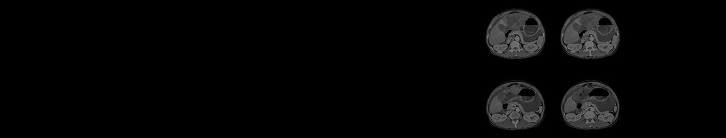 Abdominal Cancer