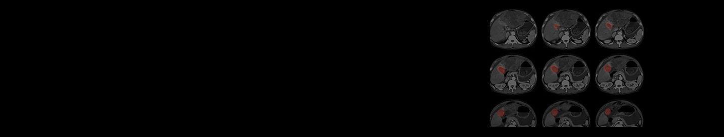 Bladder Cancer
